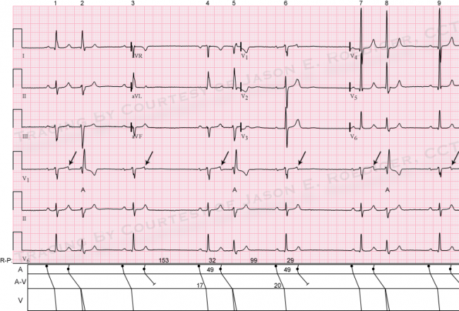 Overdrive suppression | ECG Guru - Instructor Resources